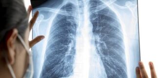 Pneumonia silenciosa preocupa médicos e pais em São Paulo; casos crescem entre crianças